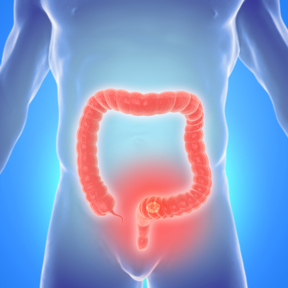 Spotlight on Colorectal Cancer