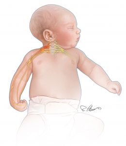 Baby with Erb's Palsy